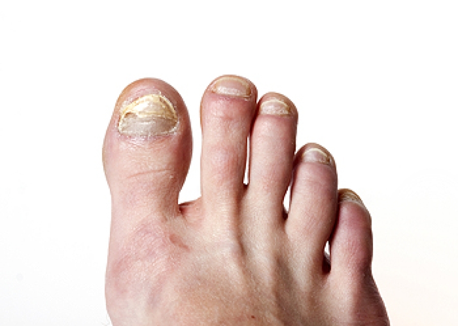 The Dangers of Ignoring Toenail Fungal Infections, black toenail fungus
