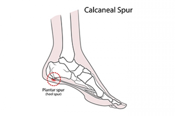 Outpatient Heel Spur Surgery Guides | Canyon Oaks Podiatry Fresno, CA